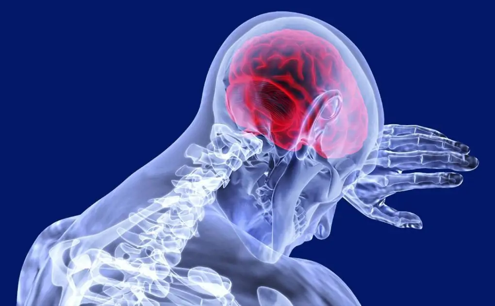 Brain Pressure Disorder That Causes Vision Problems on the Rise Due to Rising Obesity Rates, Says Study