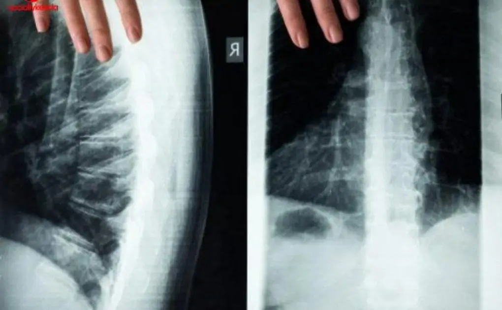 Scientists Discover Treatment of Spinal Cord Injuries