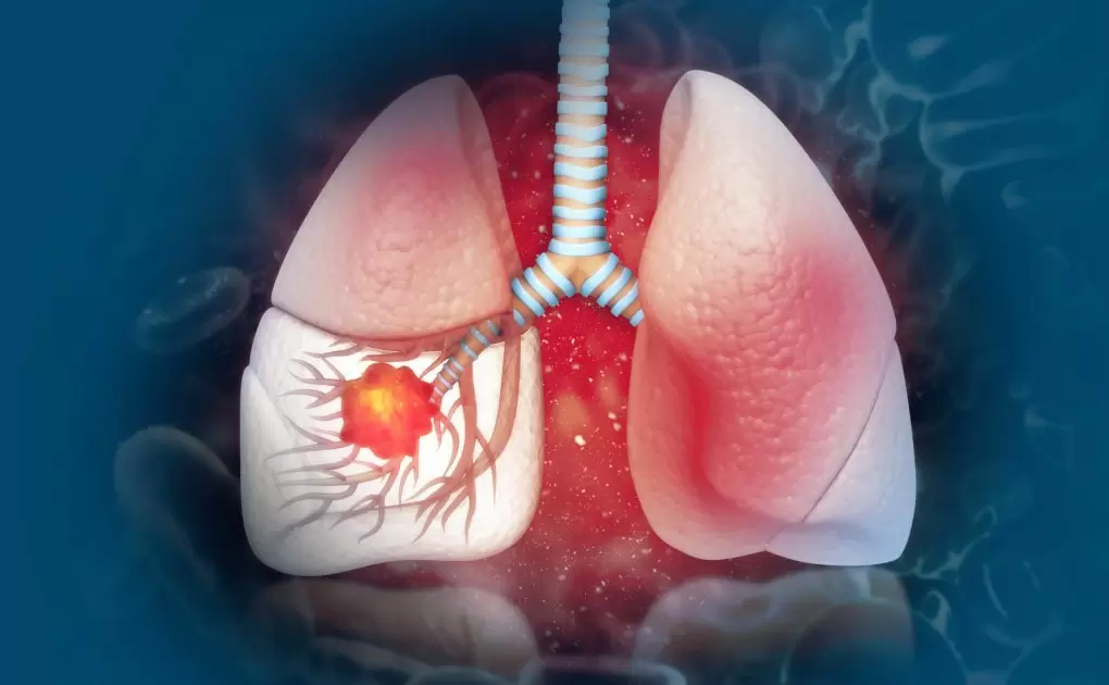 6 Common Lung Disease Symptoms To Be Aware Of
