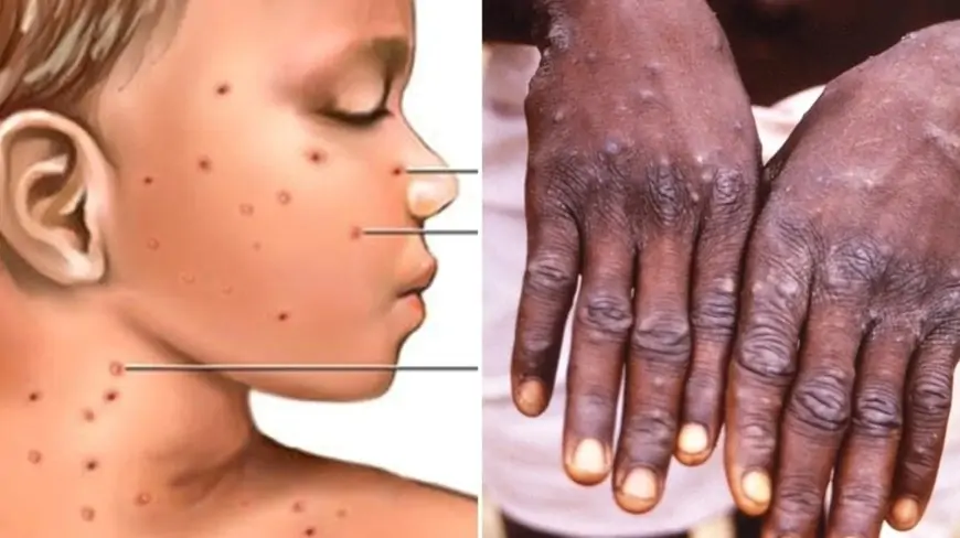 9 differences between monkeypox and chickenpox you must know about