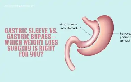Gastric Sleeve vs. Gastric Bypass – Which Weight Loss Surgery Is Right for You?