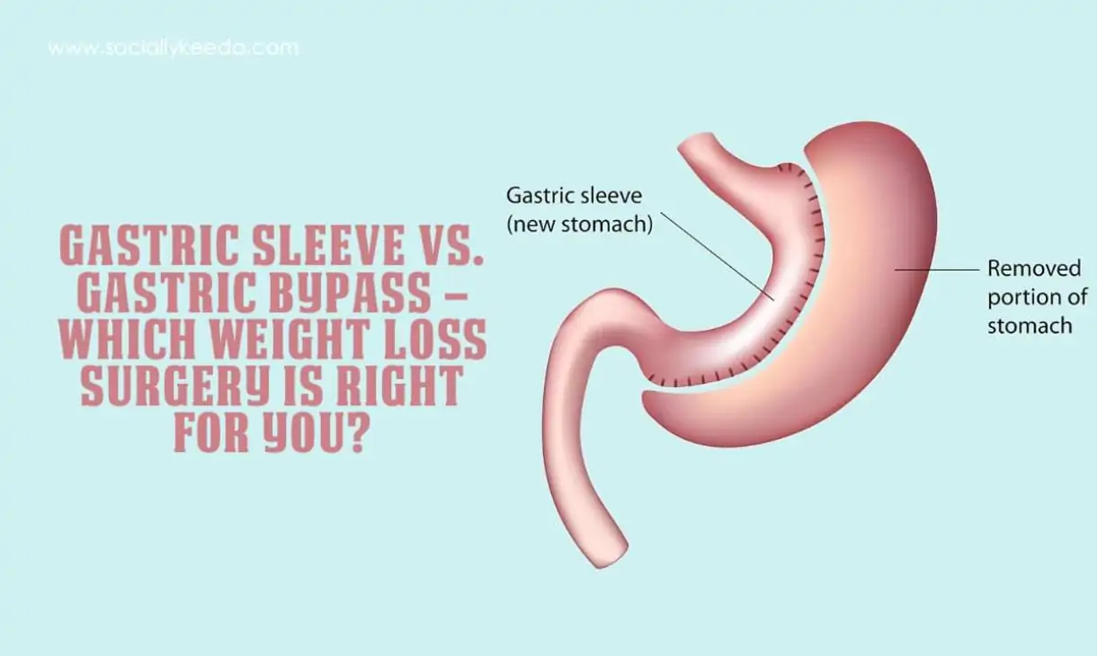 Gastric Sleeve vs. Gastric Bypass