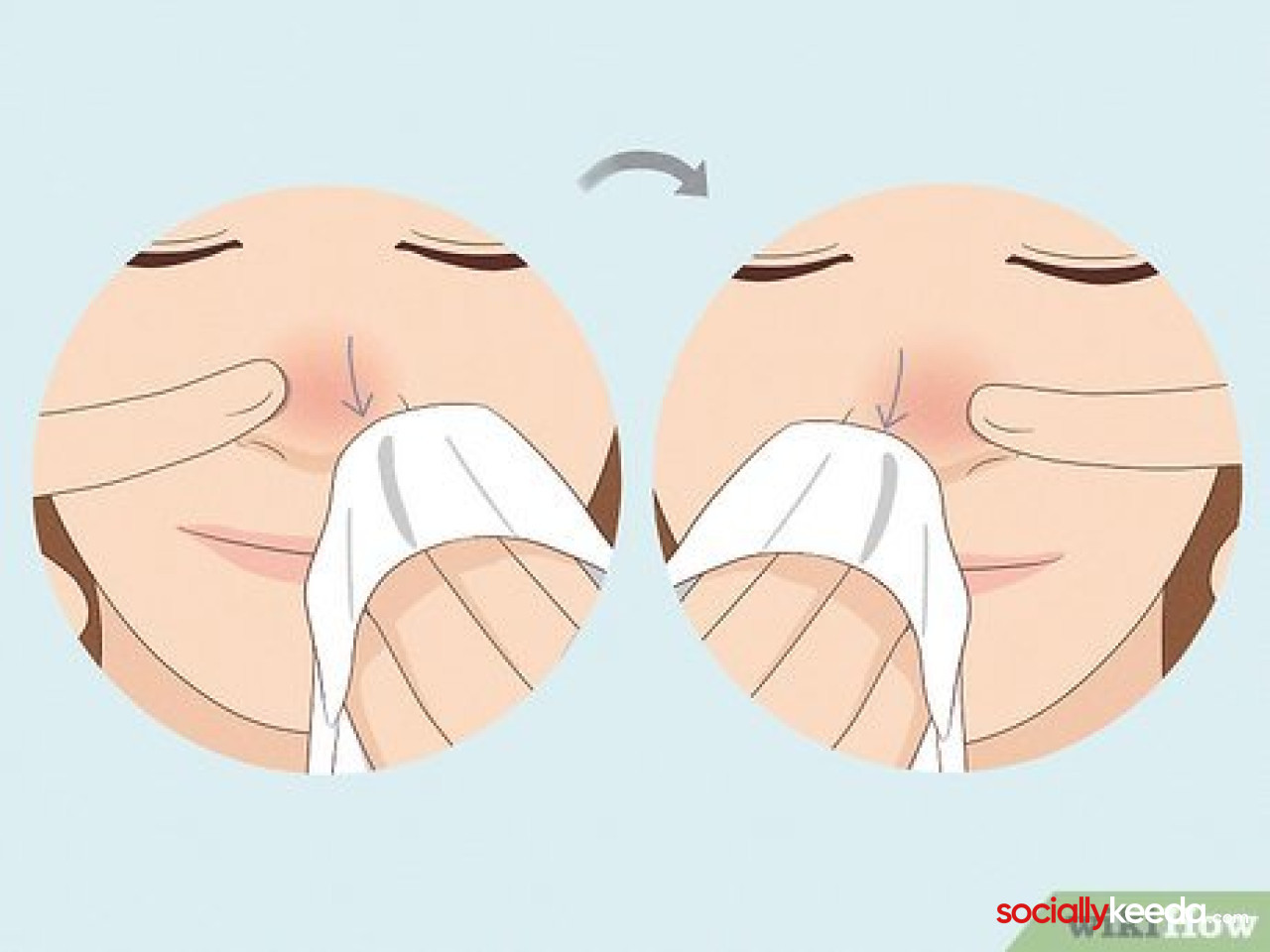 Best Ways To Get Rid of a Runny Nose
