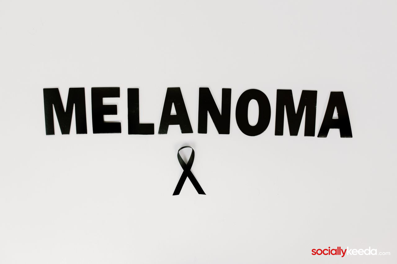 Best Ways To Get Rid Of Melanoma