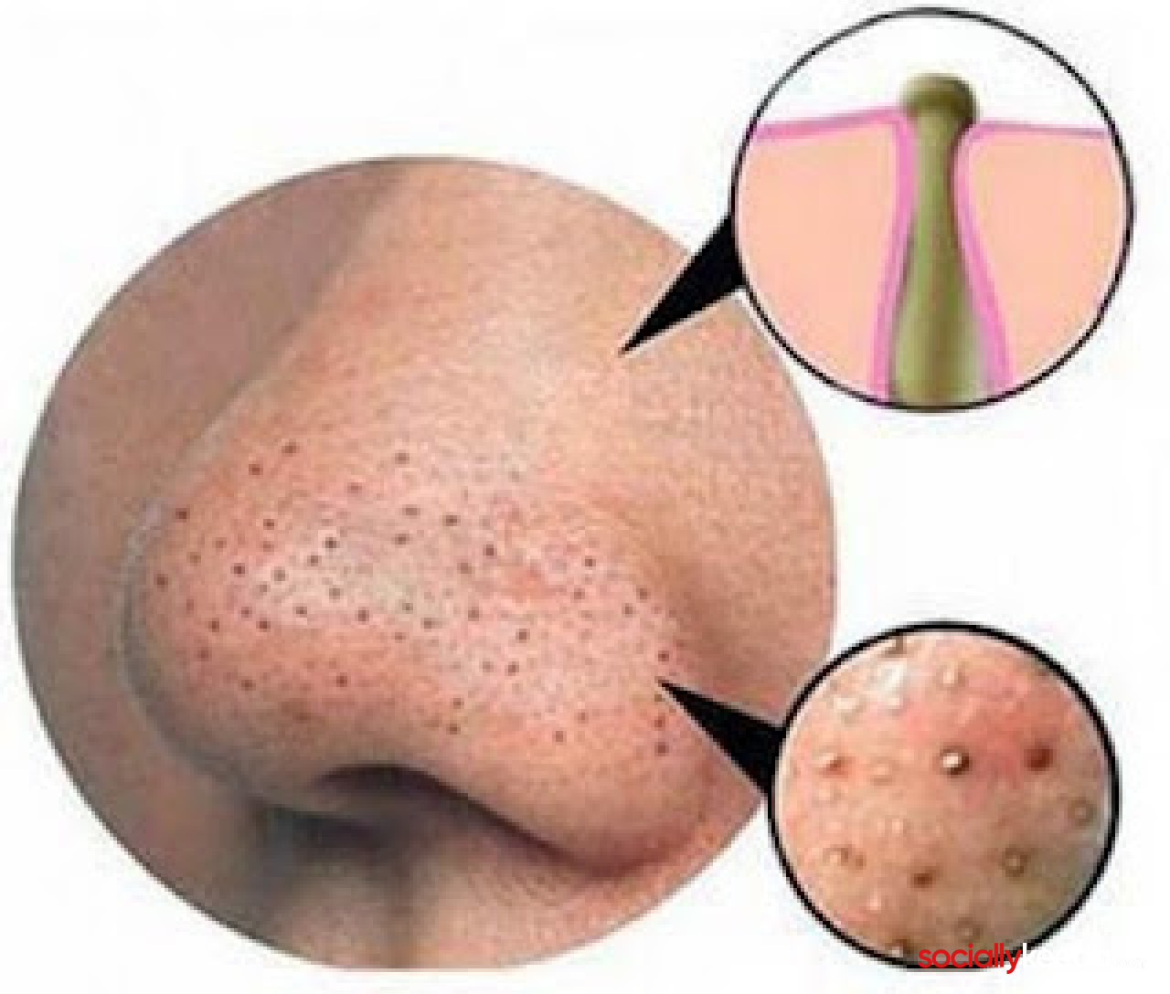 Nose Blackheads: A Step By Step Guide To Remove Blackheads On Nose