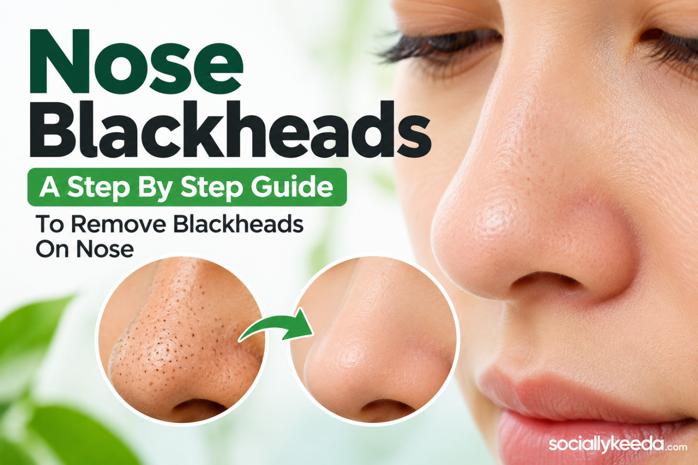 Nose Blackheads: A Step By Step Guide To Remove Blackheads On Nose