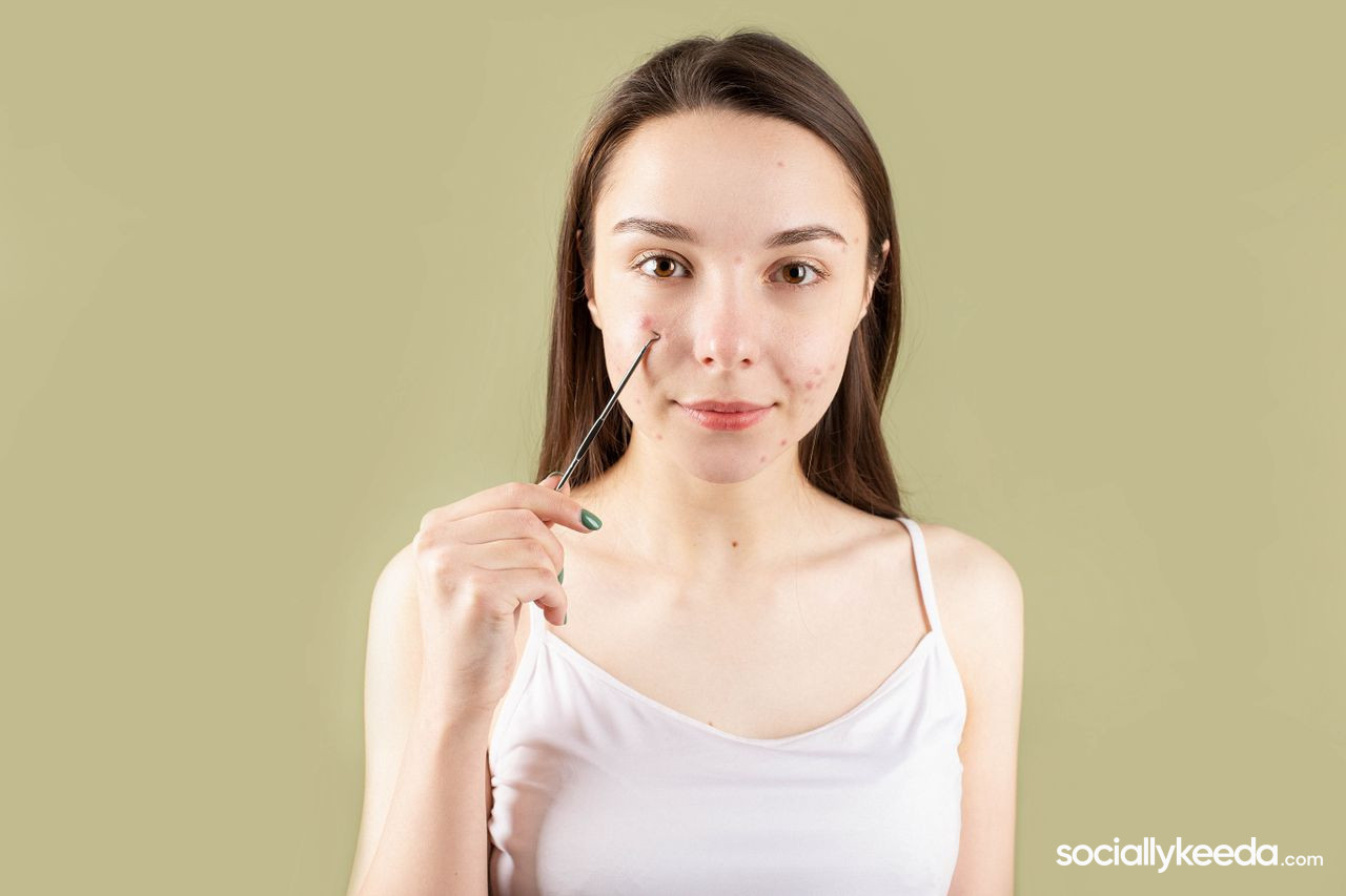Best Ways To Get Rid Of Pimples Overnight